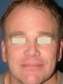 Browlift and Botox