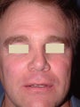 Browlift and Botox
