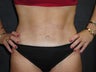 Tummy Tuck