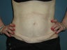 Tummy Tuck