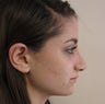Nose Surgery