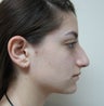 Nose Surgery