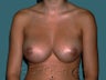 Nipple Inversion