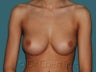 Nipple Inversion