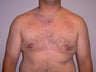 27 year old man has gynecomastia surgery