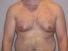 27 year old man has gynecomastia surgery