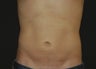 Liposuction