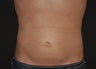 Liposuction