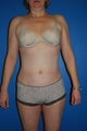 52 year old female liposuction of the abdominal wall and flanks