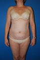 52 year old female liposuction of the abdominal wall and flanks