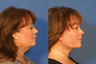 Facelift