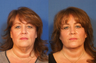 Facelift
