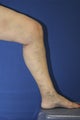 Vein Treatment