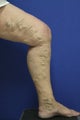 Vein Treatment