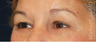 Eye Area Rejuvenation