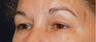 Eye Area Rejuvenation