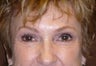 55 Year Old Female Treated for Tired Eyes