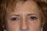 55 Year Old Female Treated for Tired Eyes