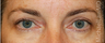 Eyelid Surgery - Blepharoplasty