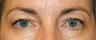 Eyelid Surgery - Blepharoplasty