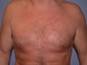 Gynecomastia on 36-year-old