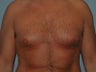 Gynecomastia on 36-year-old