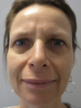 Rhinoplasty