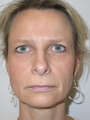 Rhinoplasty