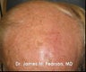 Facial Reconstruction / Mohs Reconstruction