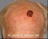 Facial Reconstruction / Mohs Reconstruction