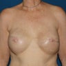 Bilateral Breast Reconstruction after Mastectomy