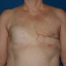 Bilateral Breast Reconstruction after Mastectomy