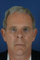 60 year male with liquid facelift