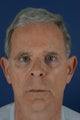 60 year male with liquid facelift