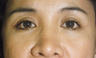 Eyelid Surgery