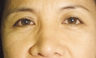 Eyelid Surgery