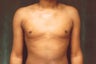 Male Breast Reduction