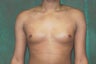 Male Breast Reduction