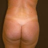 Liposuction