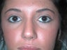 Rhinoplasty