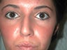 Rhinoplasty