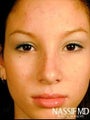 Female Primary Rhinoplasty 