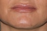 Lip Augmentation