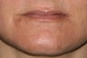 Lip Augmentation