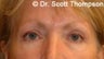 Forehead Lift/Brow Lift