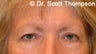 Forehead Lift/Brow Lift