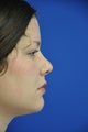 secondary rhinoplasty/revision rhinoplasty