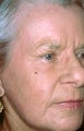 Full face laser skin resurfacing with upper and lower blepharoplasty