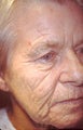 Full face laser skin resurfacing with upper and lower blepharoplasty