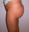 This is a 38 y.o. woman wanted to have a buttock augmentation